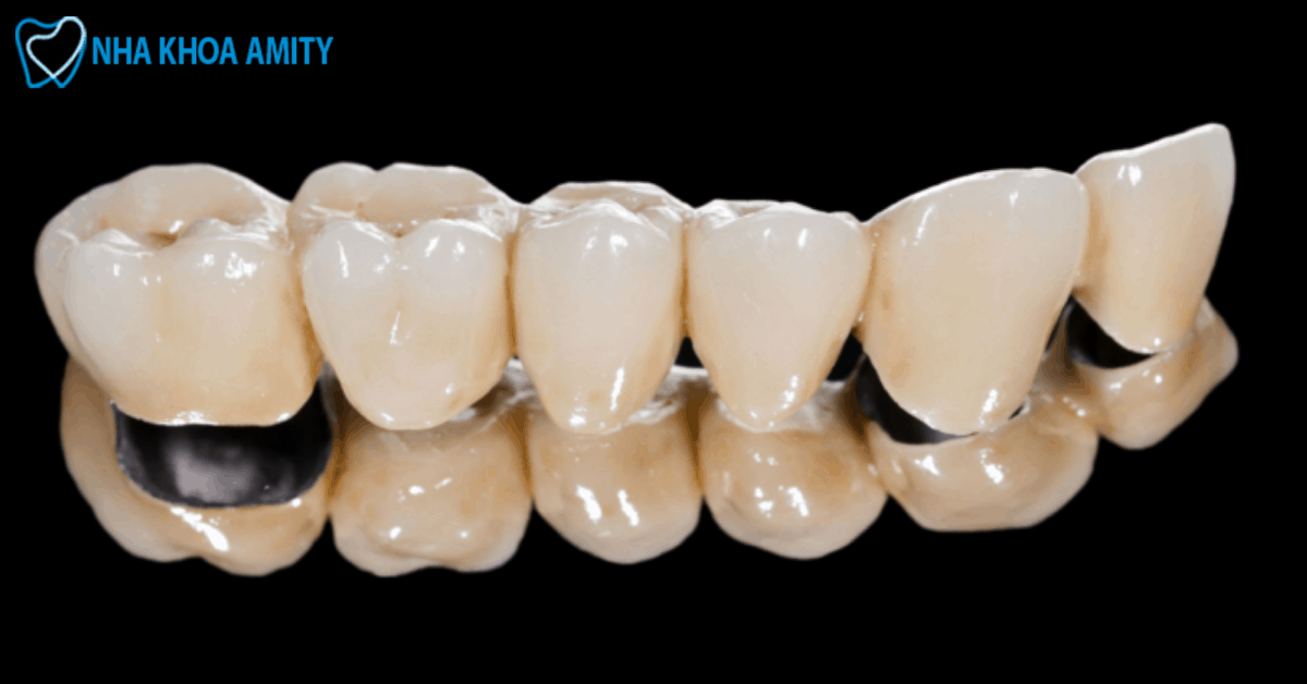 Những ưu điểm của răng sứ Titan