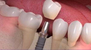 sự khác nhau giữa răng sứ titan và răng sứ kim loại