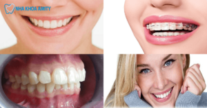 cách chữa răng hô hiệu quả