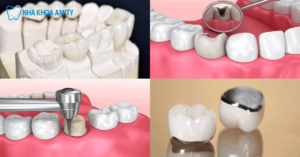 quy trình làm răng sứ hiệu quả