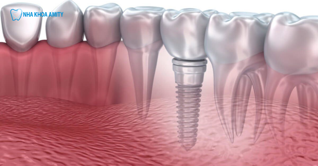 Trồng răng implant