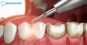 Ảnh bìa lấy cao răng
