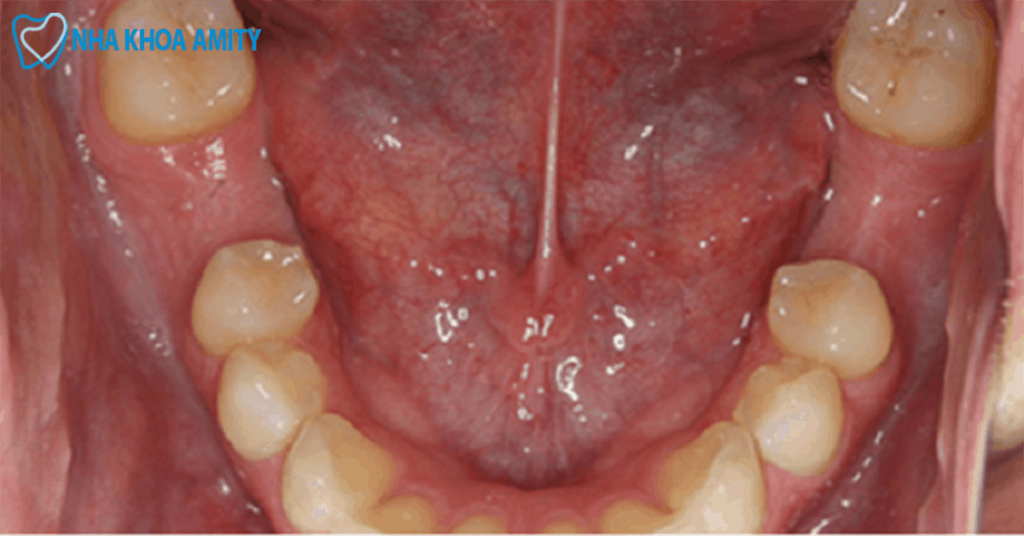 Có nên nhổ răng cấm không