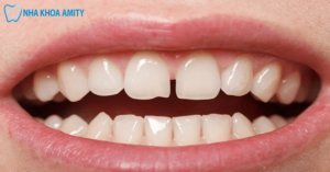 Răng Thưa Hàm Dưới Là Gì? Cách Khắc Phục Răng Thưa Hàm Dưới