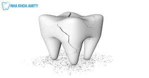Răng Bị Sứt Mẻ Nguyên Nhân Và Cách Khắc Phục