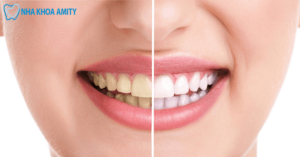 Nguyên Nhân Và Giải Pháp Khắc Phục Răng Ố Vàng