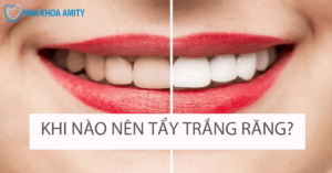 Khi Nào Nên Và Không Nên Tẩy Trắng Răng?