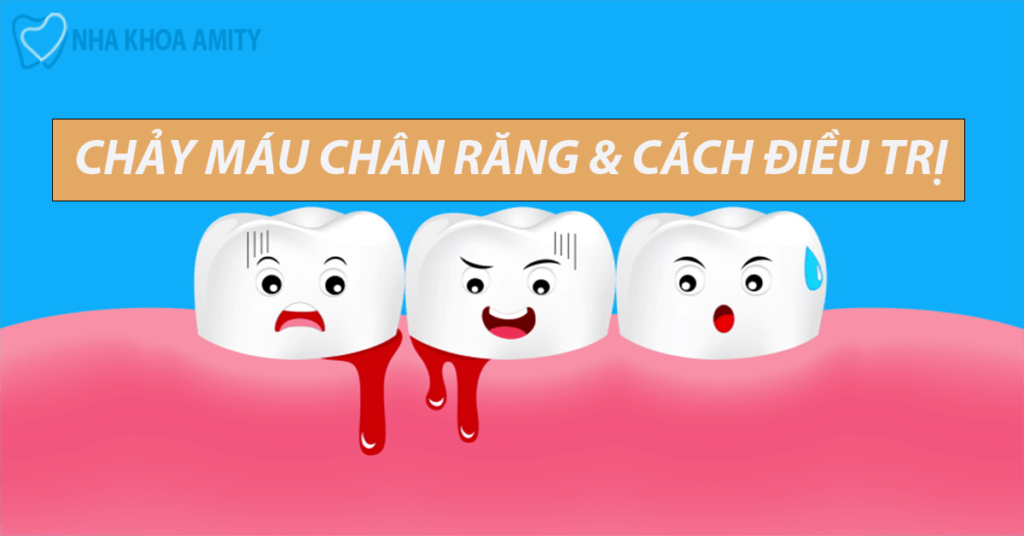 Chảy Máu Chân Răng Nguyên Nhân Và Cách Điều Trị