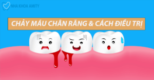 Chảy Máu Chân Răng Nguyên Nhân Và Cách Điều Trị