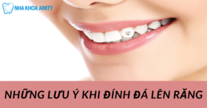 Đính Đá Lên Răng Những Lưu Ý Bạn Cần Biết