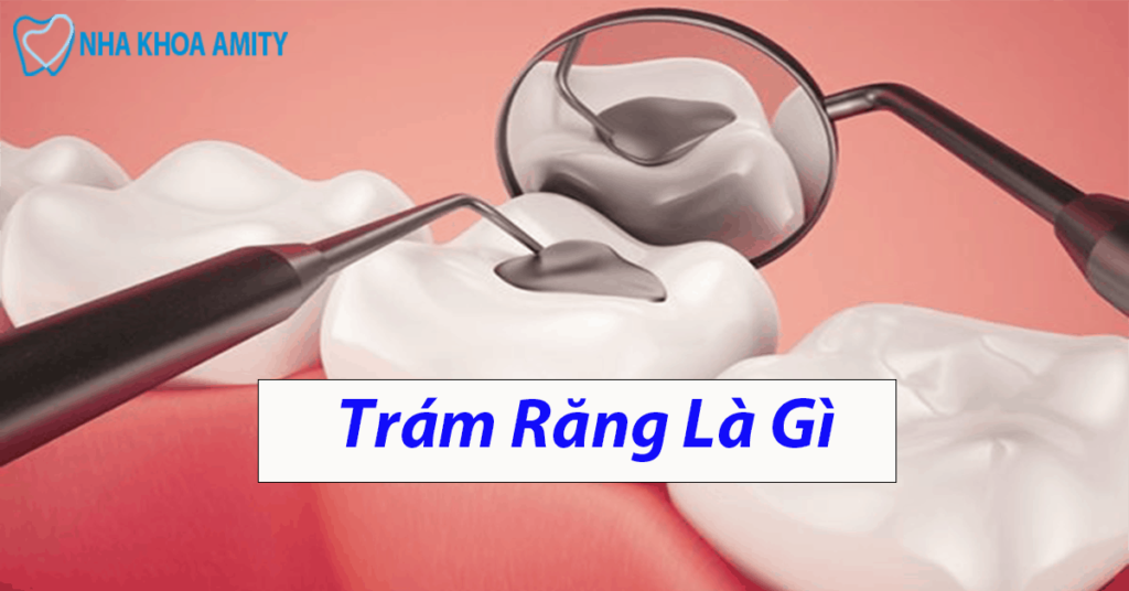 Trám Răng Là Gì? Những Điều Bạn Cần Biết