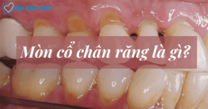 Mòn Cổ Chân Răng Là Gì? Nguyên Nhân Hướng Điều Trị