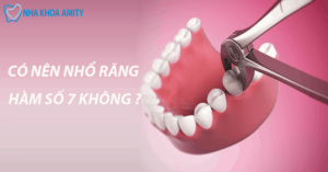 Có Nên Nhổ Răng Hàm Số 7 Không