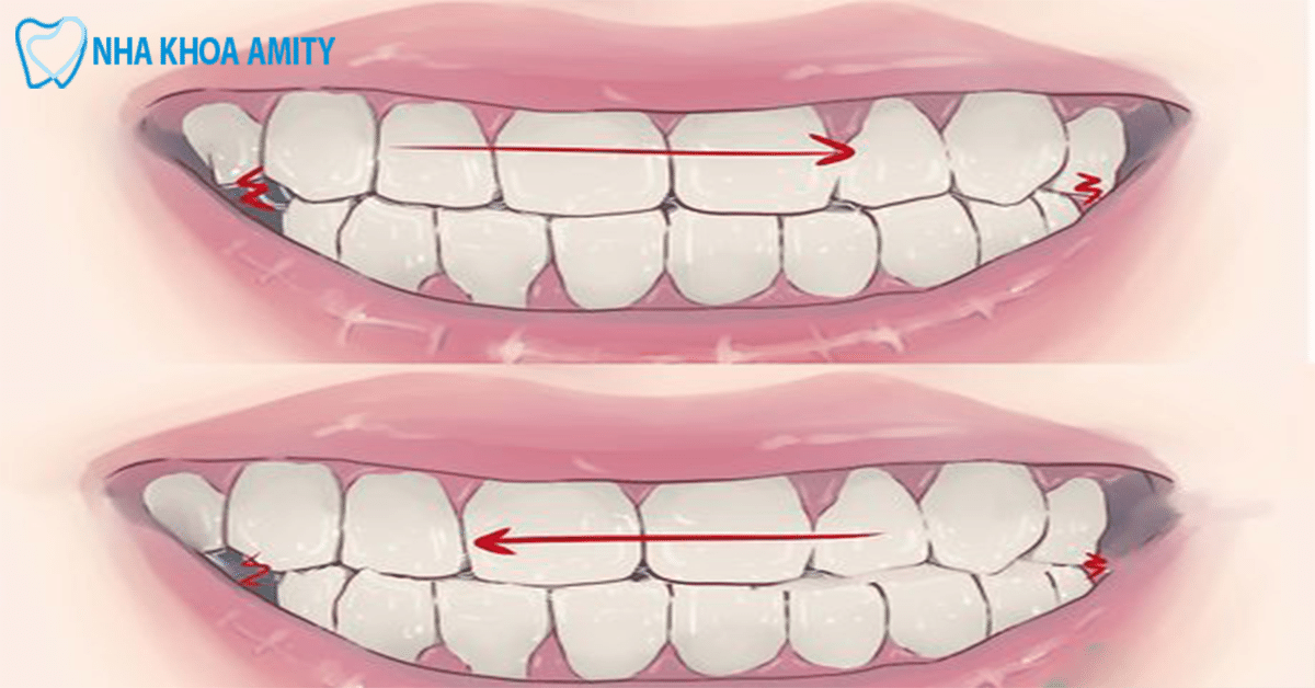 Chứng Nghiến Răng Trong Khi Ngủ Là Gì?
