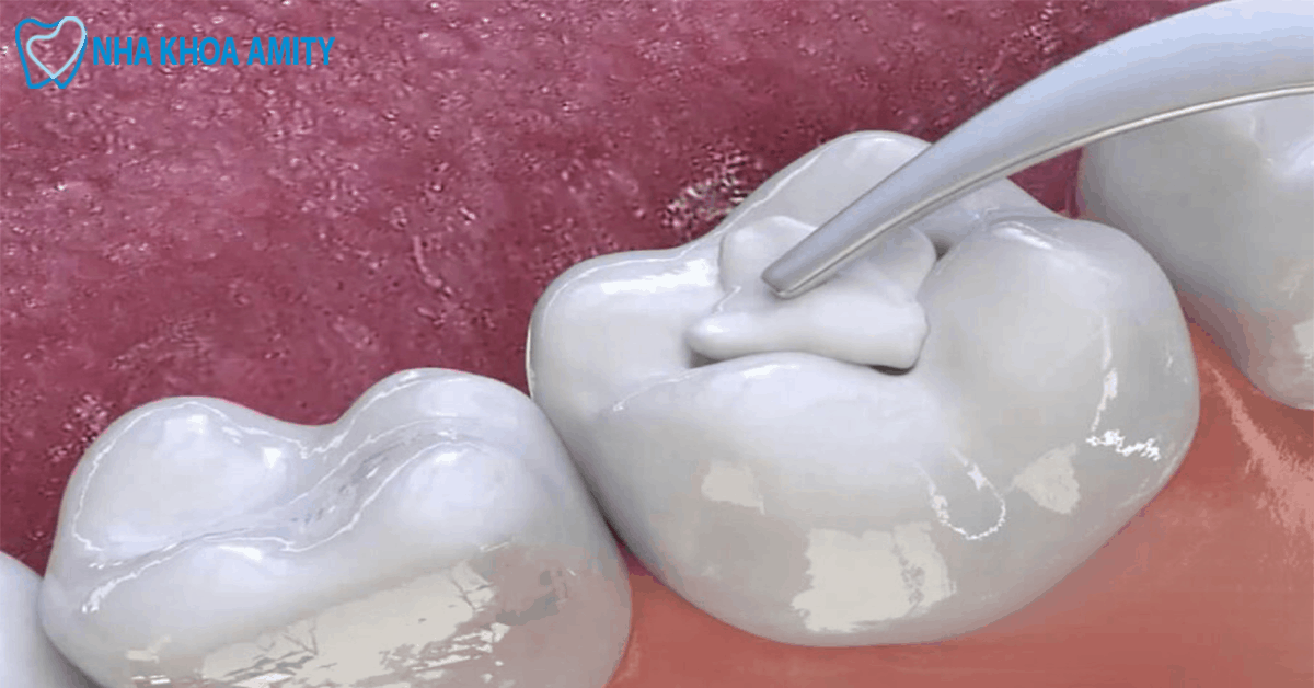 Trám Răng Là Gì?