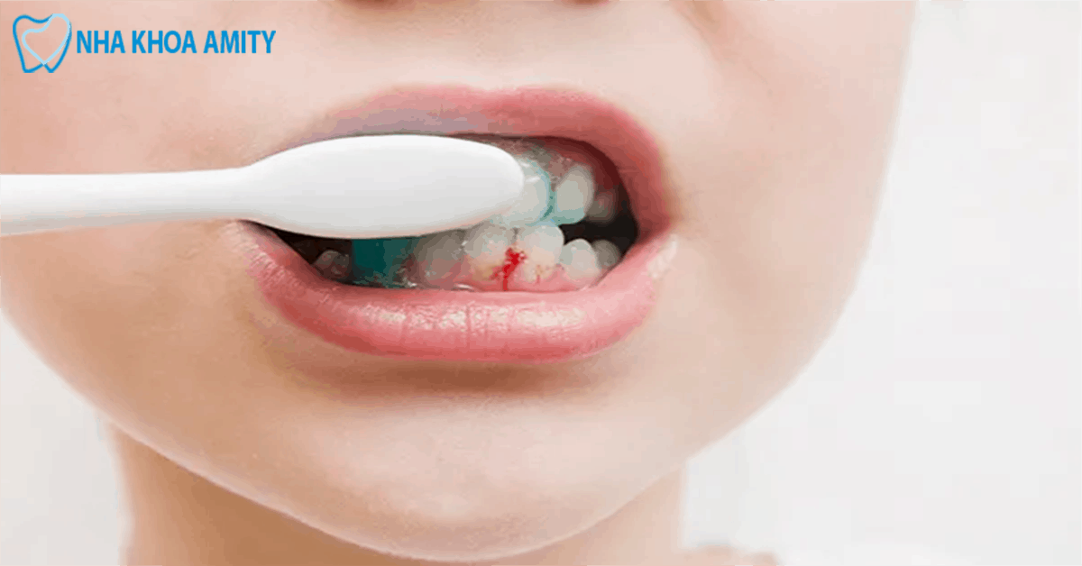 Vệ Sinh Răng Miệng Kém
