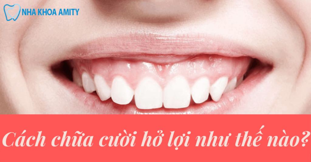 Các Phương Pháp Chữa Cười Hở Lợi