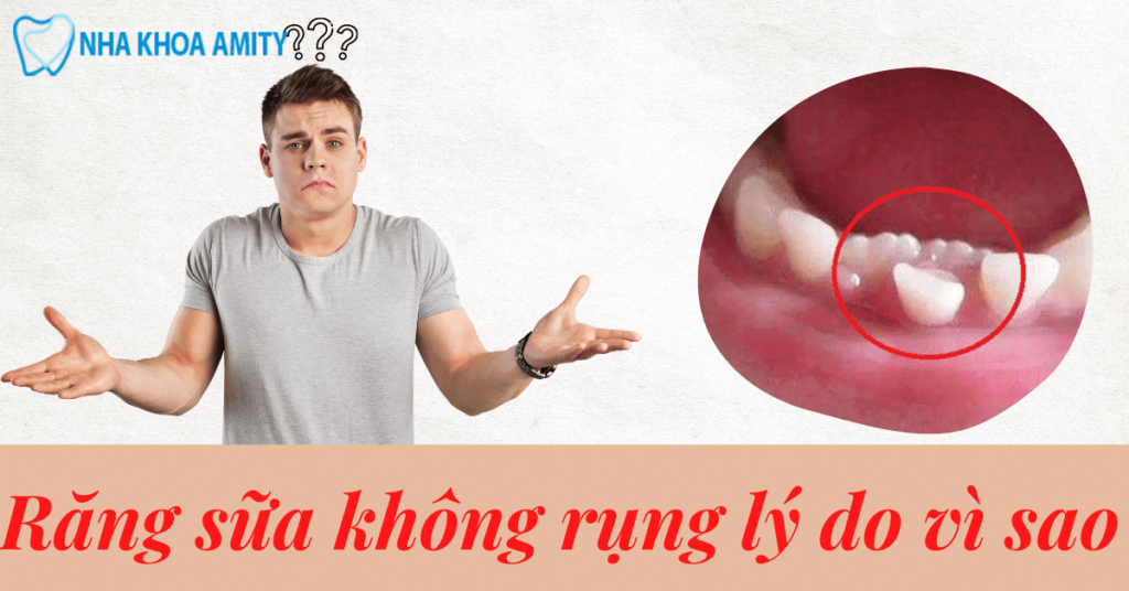 Răng Sữa Không Rụng Vì Nguyên Nhân Nào? Cách Khắc Phục
