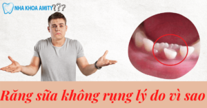 Răng Sữa Không Rụng Vì Nguyên Nhân Nào? Cách Khắc Phục