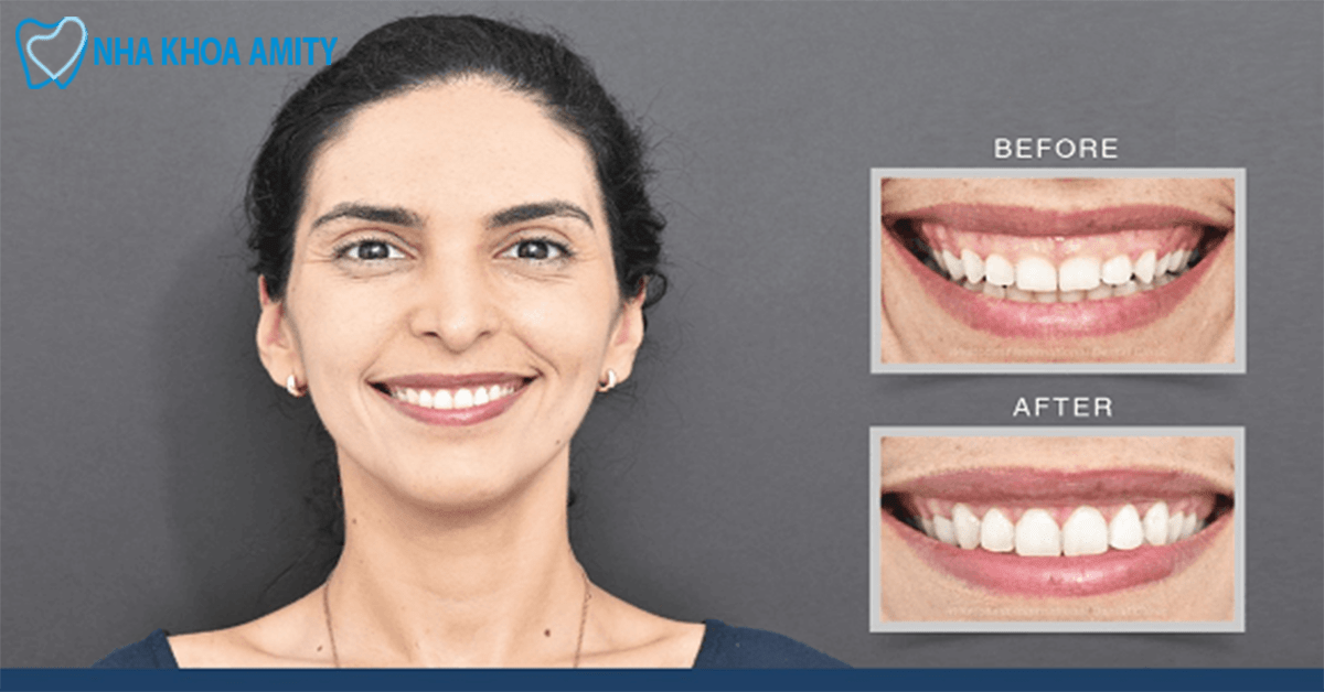 Cười Hở Lợi Là Gì? Các Dạng Cười Hở Lợi